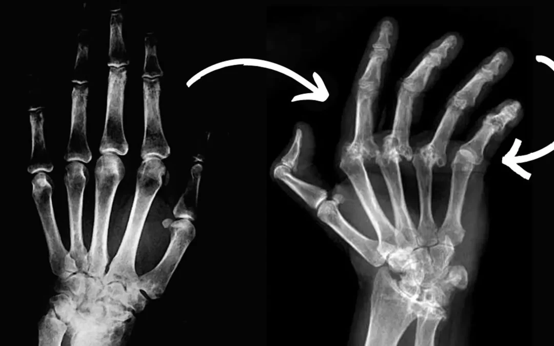Descubren que un fármaco común mejora los síntomas de la artritis de manos.
